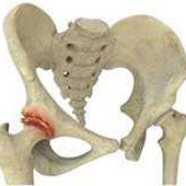 Osteoarthritis of Hip
