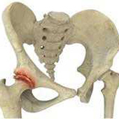 Hip Arthritis