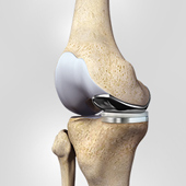 Robotic Partial Knee Replacement