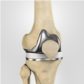 Robotic Total Knee Replacement